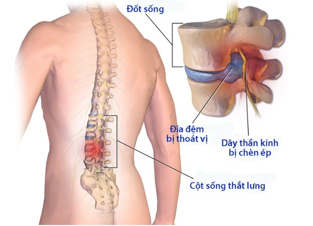 Lương y Trần Văn Lùng chuyên chữa xương khớp, thoát vị đĩa đệm