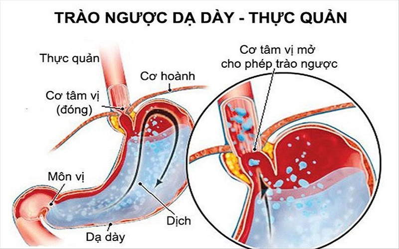 Những bài thuốc Y học cổ truyền chữa trào ngược dạ dày  thực quản hiệu quả, an toàn