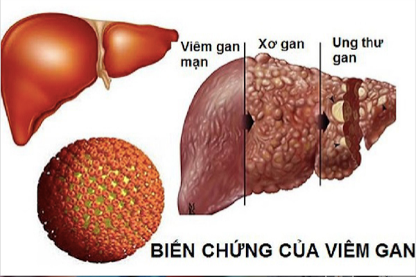 7 bài thuốc hỗ trợ điều trị viêm gan mạn tính