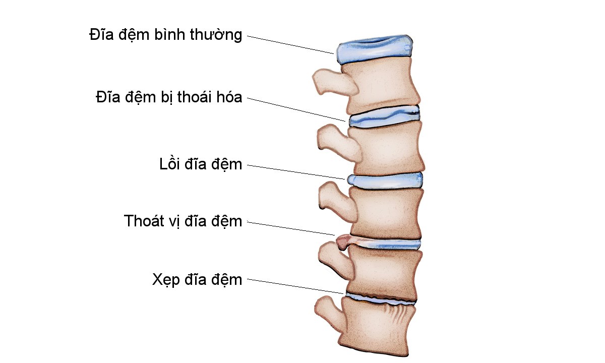 Lương y Trần Văn Lùng chuyên chữa xương khớp, thoát vị đĩa đệm