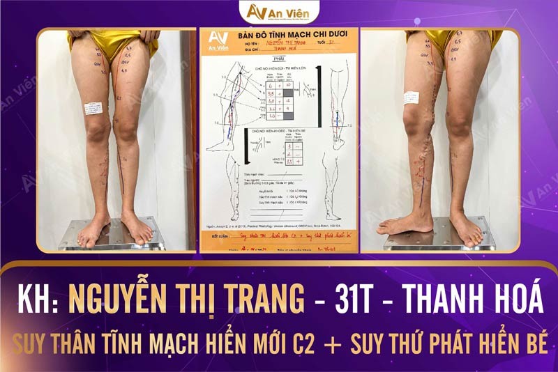 Lương y Phạm Ngọc  Khánh rất thành công chữa bệnh tĩnh mạch và thiếu máu cơ tim.