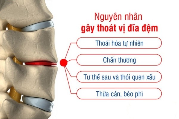 Thoát vị đĩa đệm và các bài thuốc y học cổ truyền chữa thoát vị đĩa đệm hiệu quả, an toàn