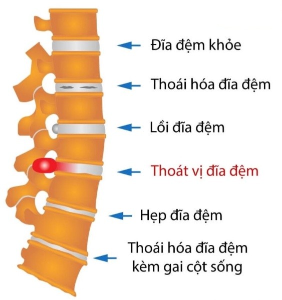 Thoát vị đĩa đệm và các bài thuốc y học cổ truyền chữa thoát vị đĩa đệm hiệu quả, an toàn