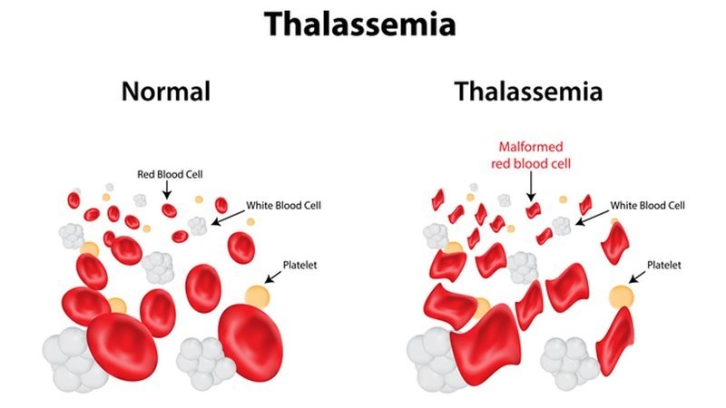 Ông Tôn Thất Dũng chữa bệnh tan máu bẩm sinh (Thalassemia) bằng cả con tim và tấm lòng của người làm thuốc