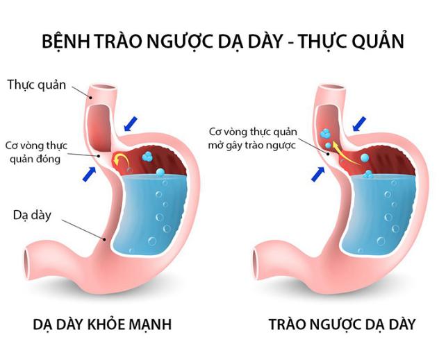 Những bài thuốc Y học cổ truyền chữa trào ngược dạ dày  thực quản hiệu quả, an toàn