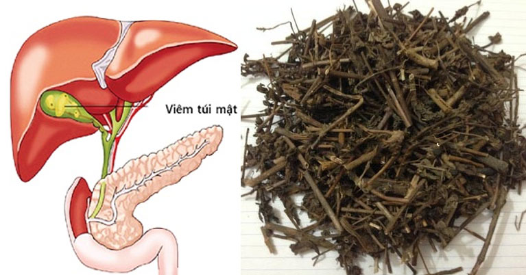 Bài thuốc từ nhân trần hỗ trợ điều trị viêm túi mật và sỏi mật